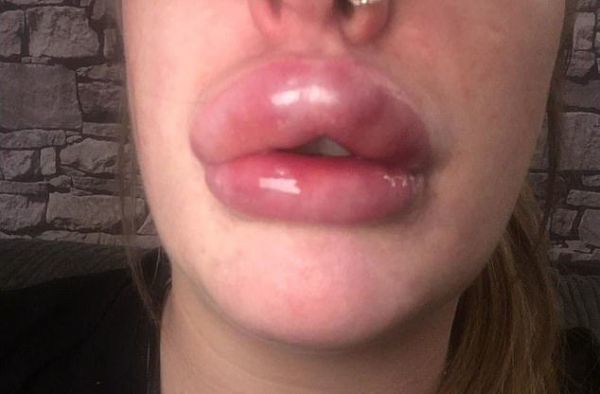 Невдала операція зі збільшення губ перетворила жінку в качечку. Бережіть себе!