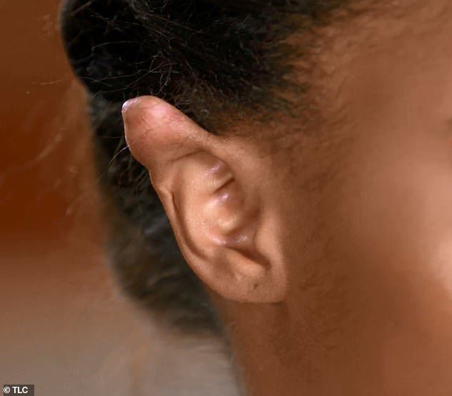 Після пірсингу вух, дівчина перетворилася в ельфа. У неї почали боліти вуха, а у верхній їх частині з хряща почала зростати рубцева тканина.