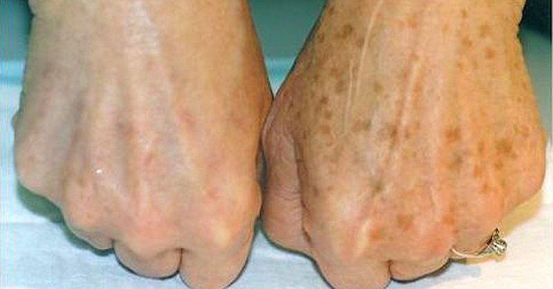 Як в домашніх умовах прибрати пігментні плями на руках — копійчаний засіб. Після 40 років у багатьох людей з'являються пігментні плями на шкірі.