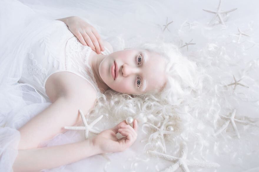 Міжнародний день поширення інформації про альбінізм — 13 червня. Вроджене порушення — альбінізм, викликається частковою або повною відсутністю меланіну — пігменту, який відповідає за колір шкіри, очей і волосся.