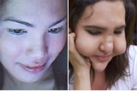 Трьом подругам з Філіппін ввели під шкіру дешеві філери і ось що стало з їхніми обличчями. Приголомшлива історія трьох філіппінок.
