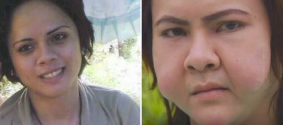 Трьом подругам з Філіппін ввели під шкіру дешеві філери і ось що стало з їхніми обличчями. Приголомшлива історія трьох філіппінок.