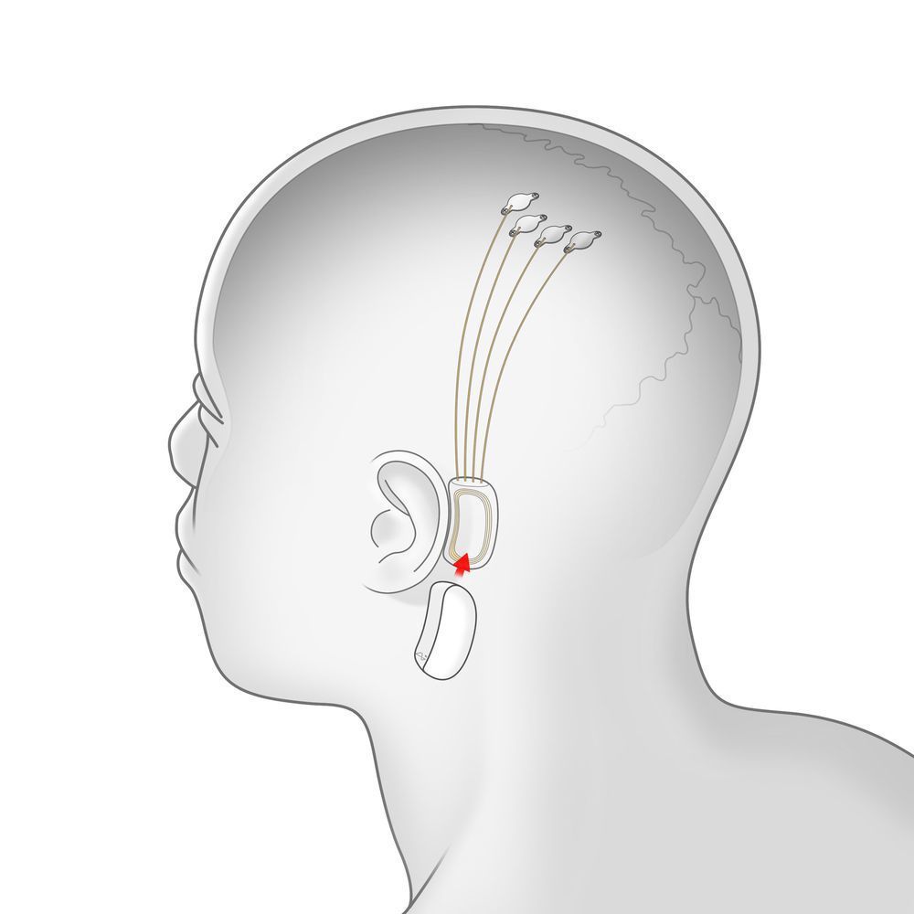 Ілон Маск представив технологію імплантації в мозок ниток, що зчитують інформацію. Розробка вже пройшла випробовування на гризунах.