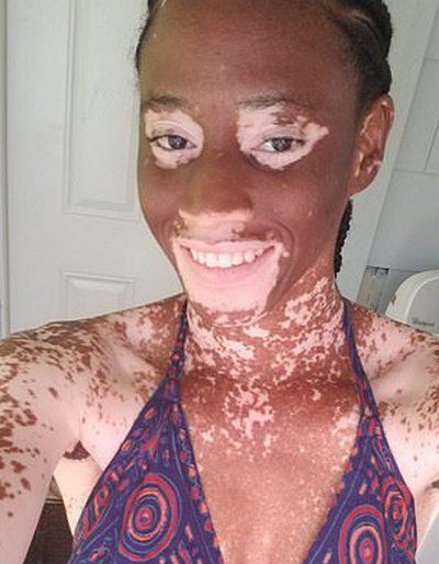 Зміна раціону, дівчини з хворобою вітиліго, на веганську дієту, допомогла повернути свій справжній темний колір шкіри. Нове харчування повернуло дівчині з хворобою вітиліго її колір шкіри.