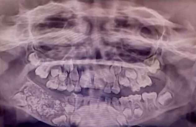 В Індії у 7-річного хлопчика видалили 526 зубів. Виявилося, це рідкісне захворювання — складна композитна одонтома.