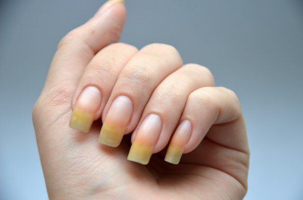 Чому жовтіють нігті і як знову зробити їх білими. Такий колір нігтів може бути з різних причин.