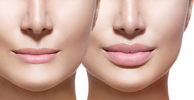 Чи безпечно збільшувати губи за допомогою гіалуронової кислоти. Давайте з'ясуємо, наскільки небезпечно збільшувати губи за допомогою гіалуронової кислоти.