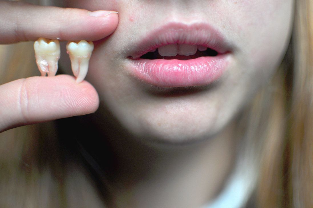 Чому зуби мудрості називаються саме так, а не інакше. Походження назви цих зубів має декілька версій.