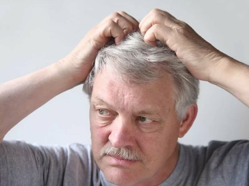 10 причин свербіння шкіри голови та способи, як його позбутися. Цей симптом дуже неприємний і його треба позбутися.