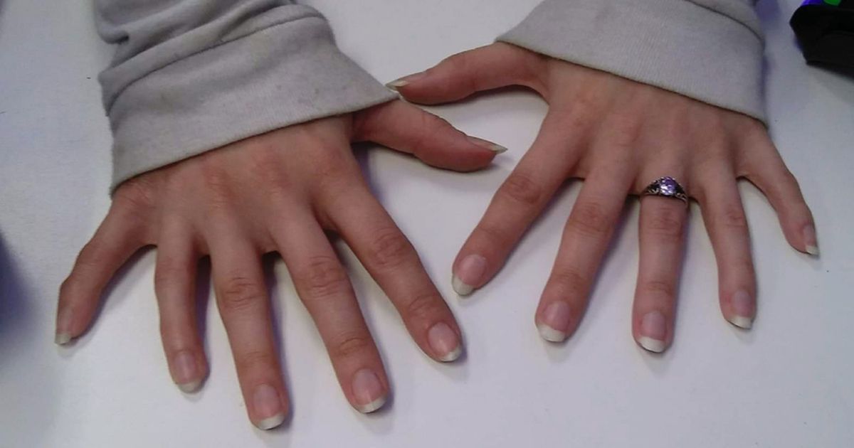 Вчені встановили, що людям було б дуже корисно мати шості пальці на руках. Полідактилія визнана вченими корисною для людей.