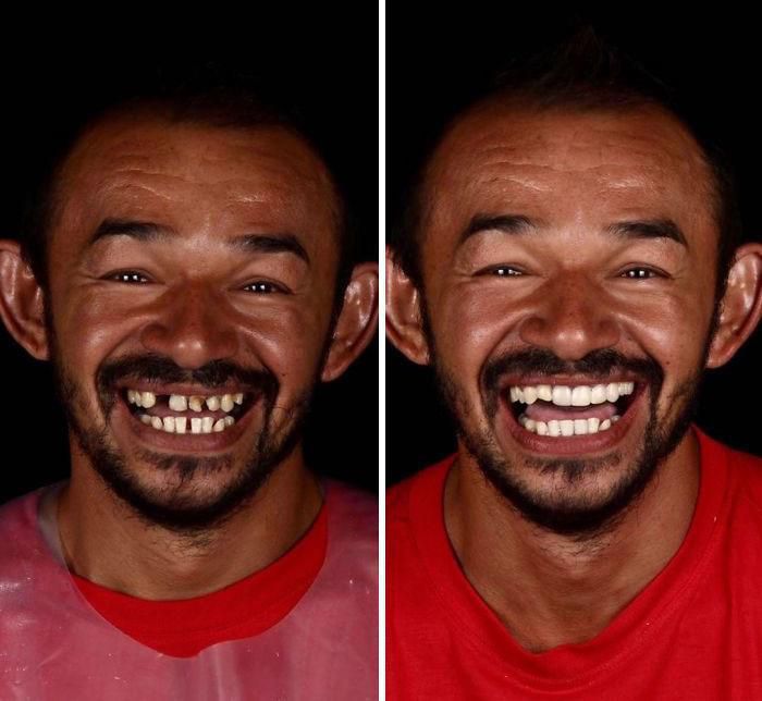 Стоматолог з Бразилії подорожує по світу, щоб безкоштовно лікувати зуби бідним. Ось 20 трансформацій.