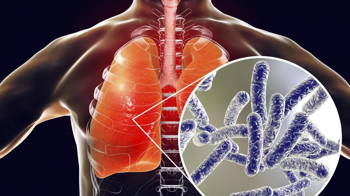 Знайдена бактерія для трансформації туберкульозу. Туберкульоз є одним з найбільш заразних захворювань у світі.
