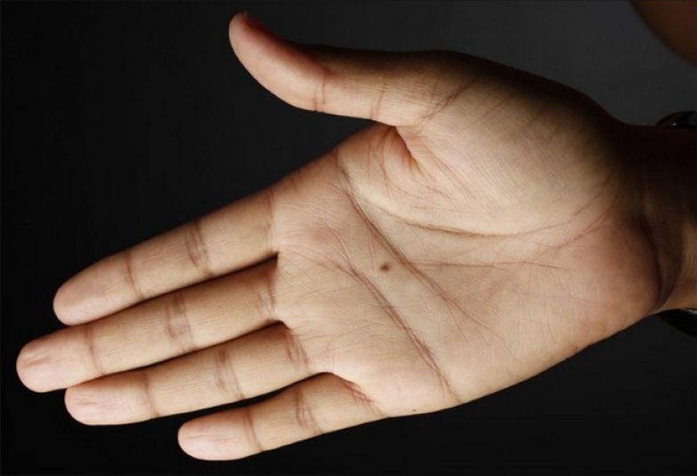 Родимки на долонях і пальцях рук: що вони розкажуть про людину. Як вони впливають на життя свого власника.