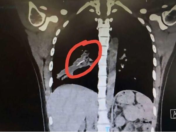Дівчина страждала через кашель 14 років і лікарі ніяк не могли пояснити цей симптом, поки вона випадково не потрапила на томографію. Виявилося, що справа у курячій кістці, яка ще у дитинстві потрапила у дихальні шляхи дівчини.