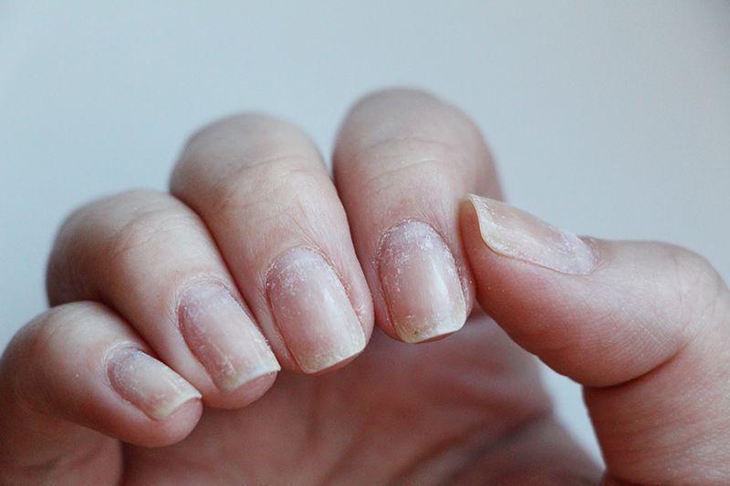 Як врятувати нігті після шелаку: кілька корисних порад. Відновити нігті після шелаку можливо.