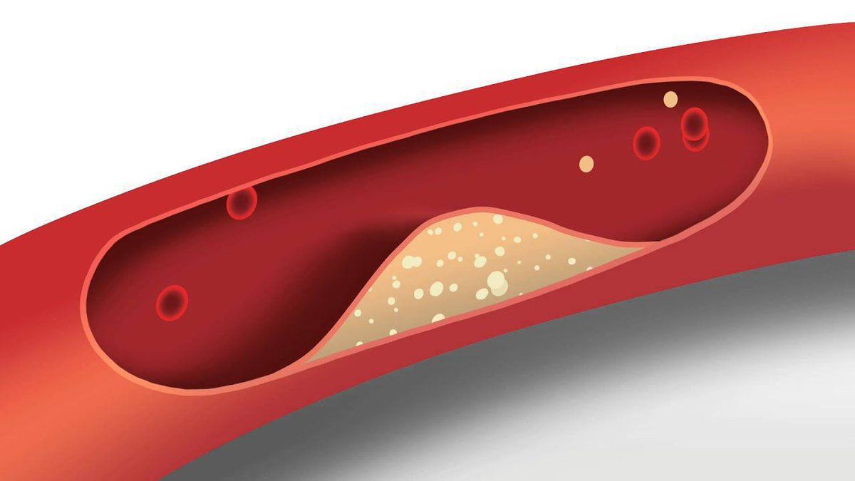 Медики розповіли про простий спосіб очищення судин від шкідливого холестерину. Очищати судини від холестеринових бляшок можна й у досить простий спосіб.