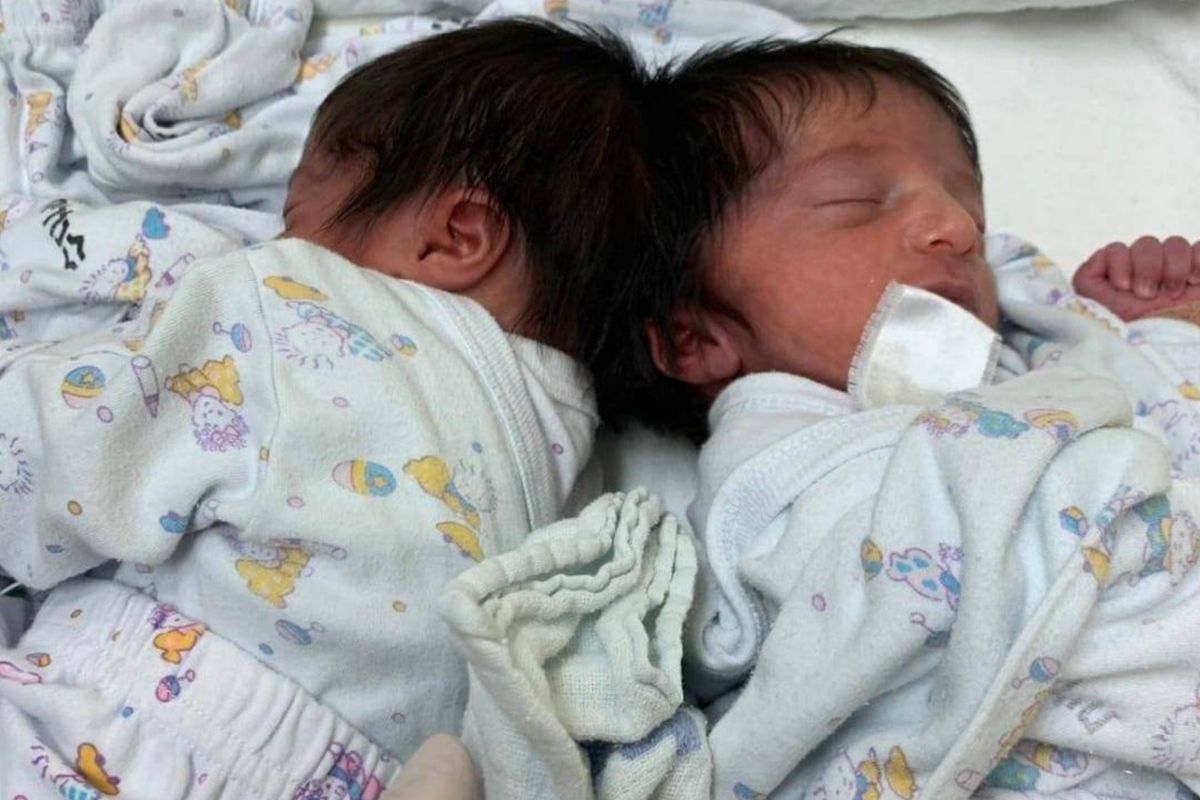 Сіамські близнята вперше побачили один одного — тільки подивіться на цей зворушливий момент. В Ізраїлі таку рідкісну і складну операцію зробили вперше, а в світі вона проводилася всього двадцять разів.