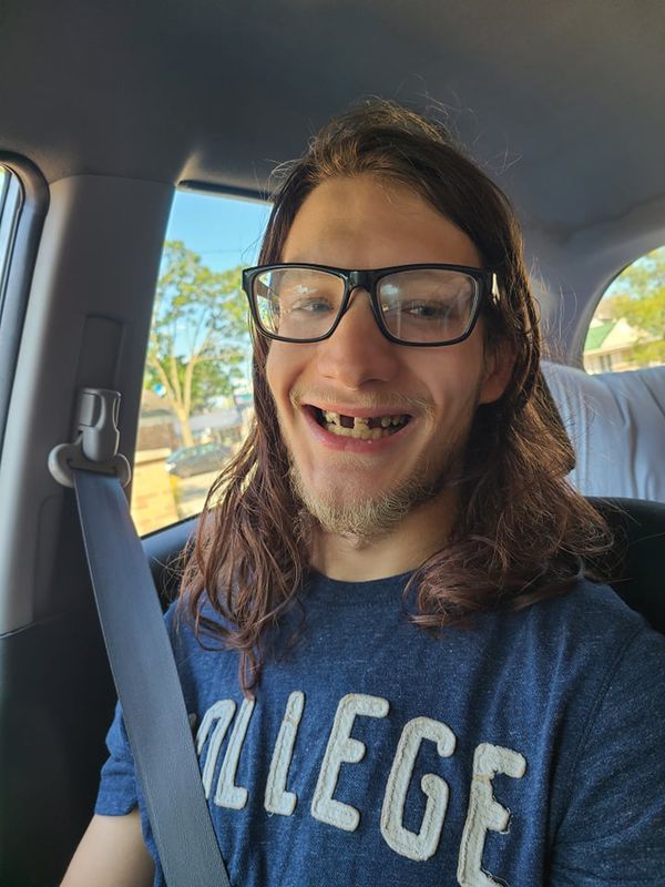 Хлопець не чистив зуби 23 роки і ось що з цього вийшло. Він залишився без зубів, але імпланти повернули йому пристойний вигляд.