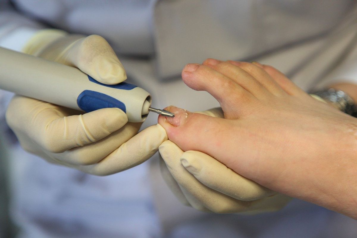 Лак для нігтів та інші фактори ризику появи грибка нігтів. Основні причини появи грибка на ногах.