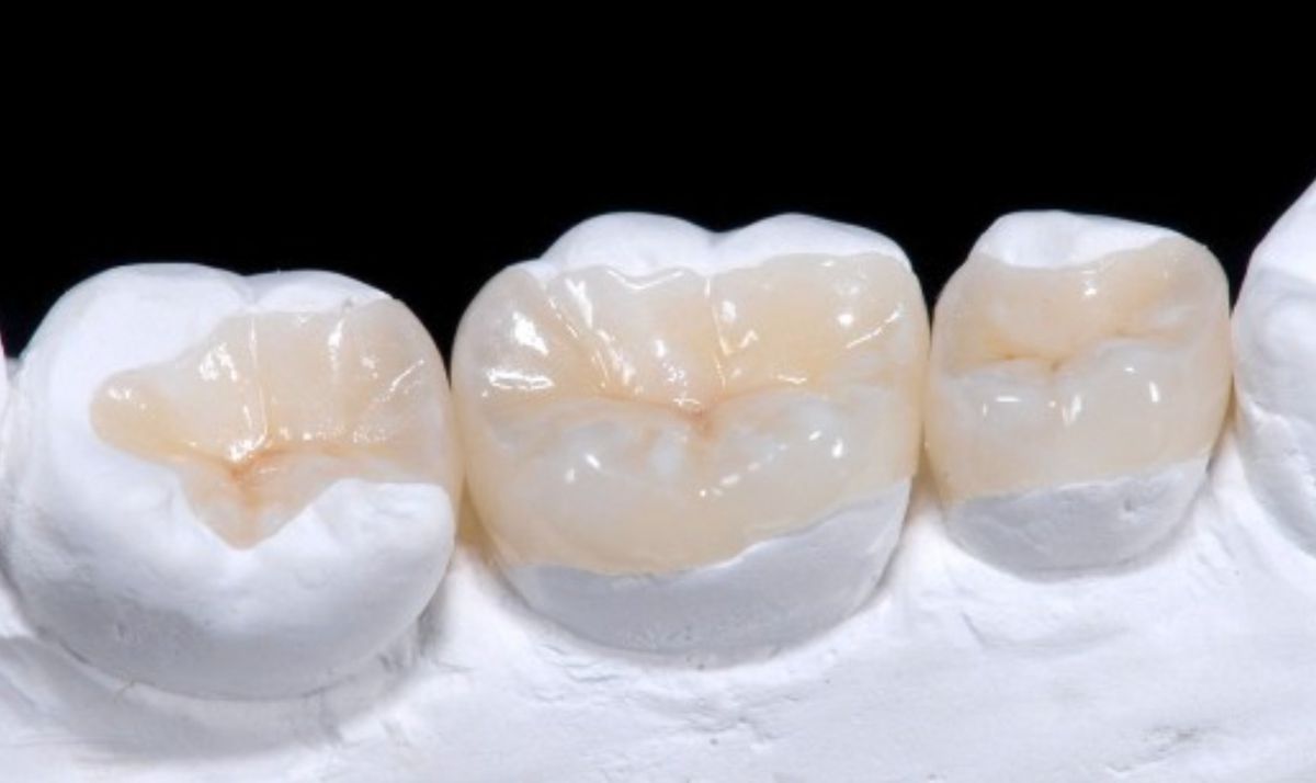 За наявності карієсу на жувальних зубах чому віддати перевагу: пломбі, коронці або керамічній вкладці. Плюси і мінуси керамічних вкладок.