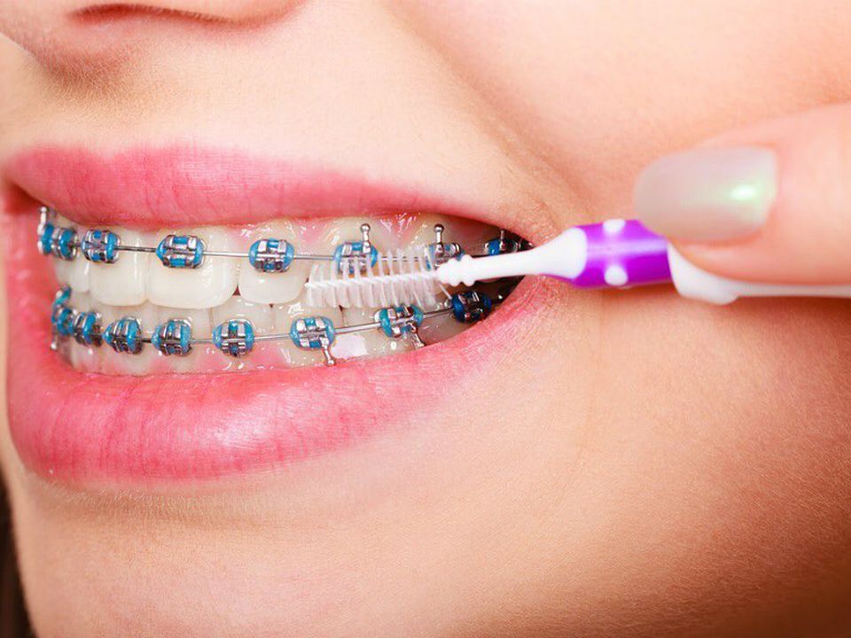 Чому безконтрольне носіння брекетів і елайнерів може завдати шкоди вашим зубам. Самолікування небезпечне для здоров'я.