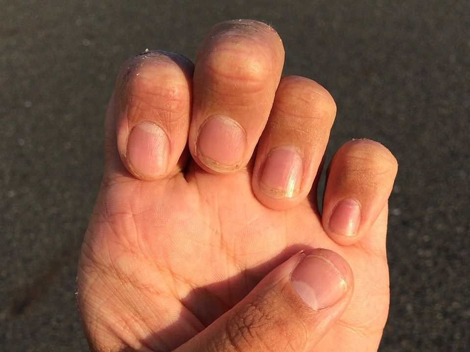 "Не пропустіть їх": Проблем з нігтями, які є симптомами захворювань. Основні проблеми з нігтями, їх симптоми та причини.